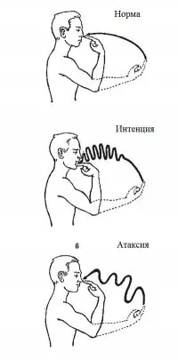 Пальценосова проба під час огляду проба