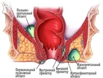 Парапроктит у дітей симптоми та лікування захворювання захворювання