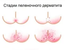 Пелюшковий дерматит, грибковий симптоми та лікування, як виглядає пелюшковий