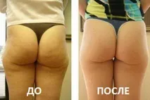Пластирі від целюліту Celluwin ефект