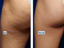 Пластирі від целюліту Celluwin целюліту