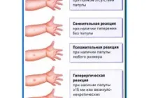Щеплення Манту дітям Манту