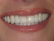 зубів