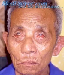 Прогноз лепри прогноз