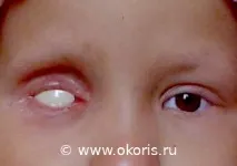 захворювання