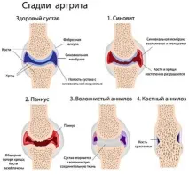 Ревматоїдний фактор показники ревматоїдний