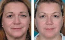Skindulgence® 30-Minute Non-Surgical Facelift System 30-minute