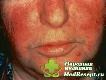 Системний червоний вовчак симптоми, причини та лікування червоний