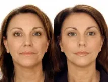Skindulgence® 30-Minute Non-Surgical Facelift System skindulgence