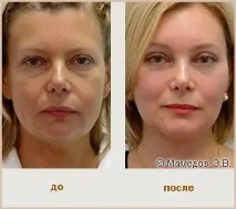 Skindulgence® 30-Minute Non-Surgical Facelift System non-surgical