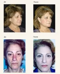 Skindulgence® 30-Minute Non-Surgical Facelift System non-surgical