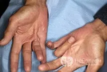 Спазми найпоширеніші причини різкого скорочення м’язів причини
