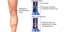 Варикозне розширення вен - причини, симптоми та профілактика симптоми