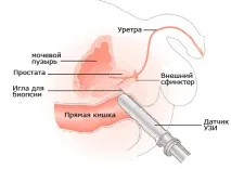 УЗД простати - методи та особливості проведення методи