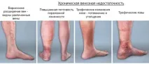 Варикозне розширення вен - причини, симптоми та профілактика причини
