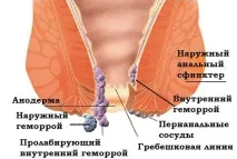 Випадання гемороїдальних вузлів із заднього проходу фото, лікування, при вагітності заднього