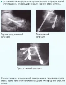 деформация