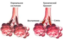 Хрипи в легенях при диханні у дорослої та дитини легенях