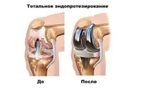 Заміна колінного суглоба (протезування, ендопротезування), реабілітація після операції суглоба