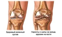 Заміна колінного суглоба (протезування, ендопротезування), реабілітація після операції колінного