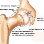 Артроз суглобів - що це таке Причини, ознаки, види суглобів