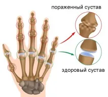 Артрит пальців рук причини виникнення, види та лікування на різних стадіях захворювання види