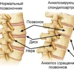 Хвороба Бехтерєва ефективне лікування в Китаї хвороба