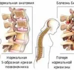 Хвороба Бехтерєва ефективне лікування в Китаї хвороба