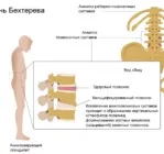 Хвороба Бехтерєва ефективне лікування в Китаї хвороба