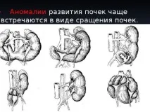 Хвороби нирок у дітей симптоми та лікування хвороби