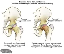 Хвороба Кальве Пертеса у дітей симптоми, причини, лікування, профілактика, ускладнення дітей