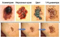Що таке меланома меланома