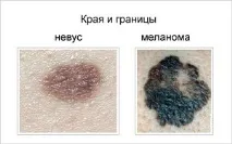 Що таке меланома меланома
