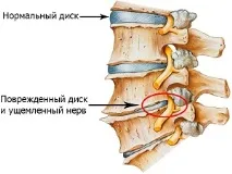 цервикалгия