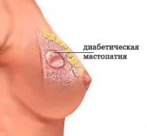Діабетична мастопатія мастопатії