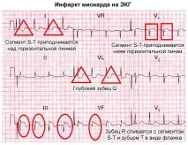 ЕКГ при інфаркті міокарда; діагностичні ознаки, визначення локалізації інфаркті