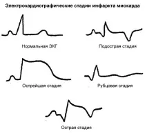 ЕКГ при інфаркті міокарда; діагностичні ознаки, визначення локалізації міокарда
