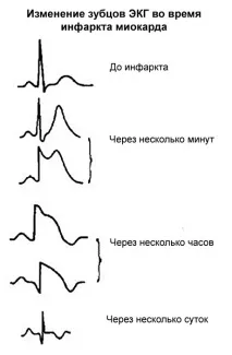 ЕКГ при інфаркті міокарда; діагностичні ознаки, визначення локалізації міокарда