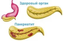 Фініки при панкреатиті можна їсти чи ні можна