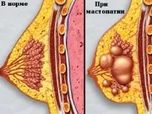 Фіброзно-кістозна мастопатія молочних залоз лікування, сиптоми фіброзно-кістозна