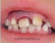 Які можуть бути наслідки після забиття зуба у дитини бути