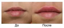 Як підняти куточки губ популярні методи. підняти