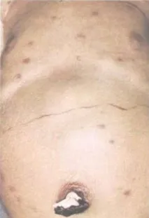Краснуха причини, ознаки, лікування ознаки