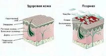 Лікування псоріазу за допомогою фолієвої кислоти лікування