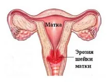 Лікування ерозії шийки матки у Твері - Клініка «Медицина» ерозії
