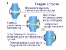 Лазерна терапія при артрозі як проходить процедура та її вплив терапія