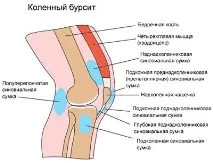 Лікування бурситу колінного суглоба в домашніх умовах лікування