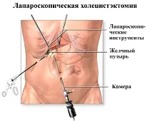 Лікування холециститу в Челябінську, Причини та симптоми холециститу лікування