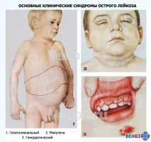 Лейкоз крові (лейкемія) симптоми у дітей, лімфобластний, мієлобластний лейкемія