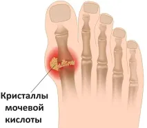 Остеохондроз та алкоголь остеохондроз